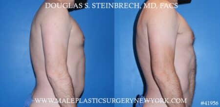 Liposuction with body banking to augment the pecs by Dr. Steinbrech