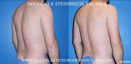 Liposuction with body banking to augment the pecs by Dr. Steinbrech