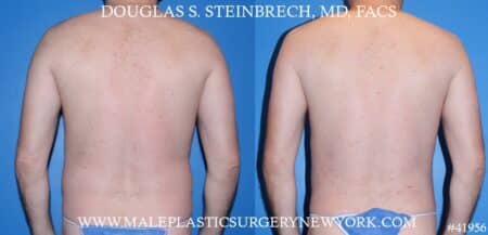 Liposuction with body banking to augment the pecs by Dr. Steinbrech