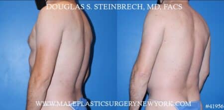 Liposuction with body banking to augment the pecs by Dr. Steinbrech