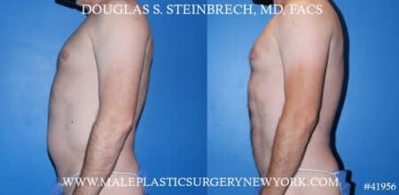 Liposuction with body banking to augment the pecs by Dr. Steinbrech