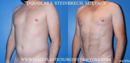 Liposuction with body banking to augment the pecs by Dr. Steinbrech