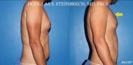 270° Torso Tuck with Body Banking to Pecs and Shoulders by Dr. Steinbrech