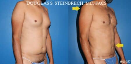 270° Torso Tuck with Body Banking to Pecs and Shoulders by Dr. Steinbrech