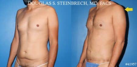 270° Torso Tuck with Body Banking to Pecs and Shoulders by Dr. Steinbrech