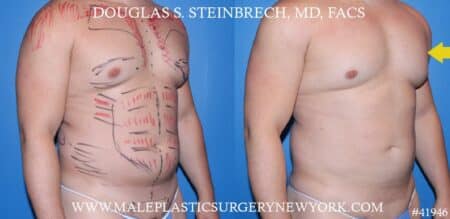 Gynecomastia treatment to improve the appearance of the chest by Dr. Steinbrech