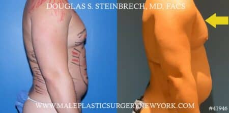 Gynecomastia treatment to improve the appearance of the chest by Dr. Steinbrech