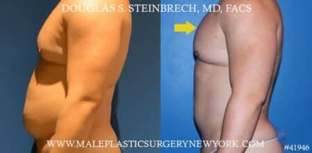 Gynecomastia treatment to improve the appearance of the chest by Dr. Steinbrech