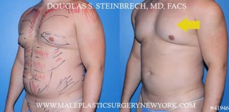 Gynecomastia treatment to improve the appearance of the chest by Dr. Steinbrech