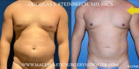 Gynecomastia treatment to improve the appearance of the chest by Dr. Steinbrech