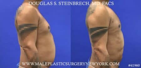 Gynecomastia treatment to shape the male chest contour by Dr. Steinbrech