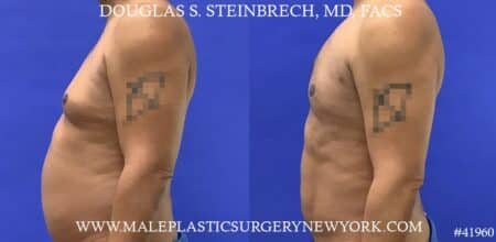 Gynecomastia treatment to shape the male chest contour by Dr. Steinbrech