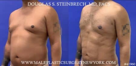 Gynecomastia treatment to shape the male chest contour by Dr. Steinbrech