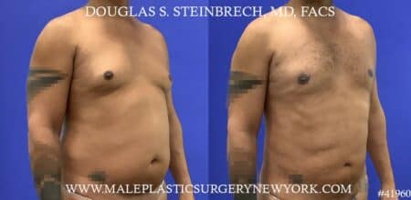 Gynecomastia treatment to shape the male chest contour by Dr. Steinbrech