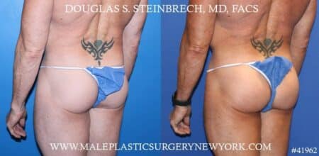 Gluteal implants to augment the buttocks by Dr. Steinbrech