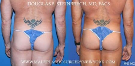 Gluteal implants to augment the buttocks by Dr. Steinbrech