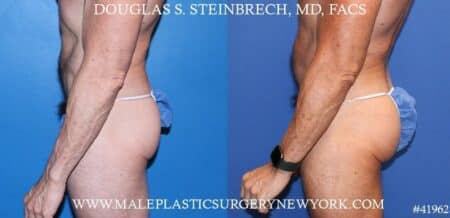 Gluteal implants to augment the buttocks by Dr. Steinbrech