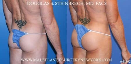 Gluteal implants to augment the buttocks by Dr. Steinbrech