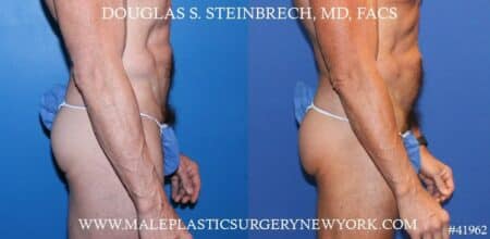 Gluteal implants to augment the buttocks by Dr. Steinbrech