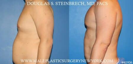 Gynecomastia treatment and pec contouring by Dr. Steinbrech