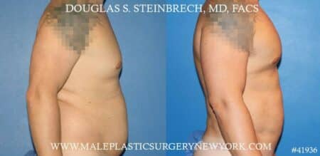 Gynecomastia treatment and pec contouring by Dr. Steinbrech