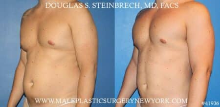 Gynecomastia treatment and pec contouring by Dr. Steinbrech