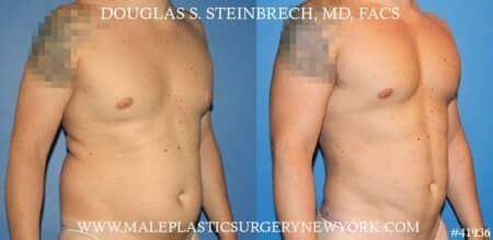 Gynecomastia treatment and pec contouring by Dr. Steinbrech