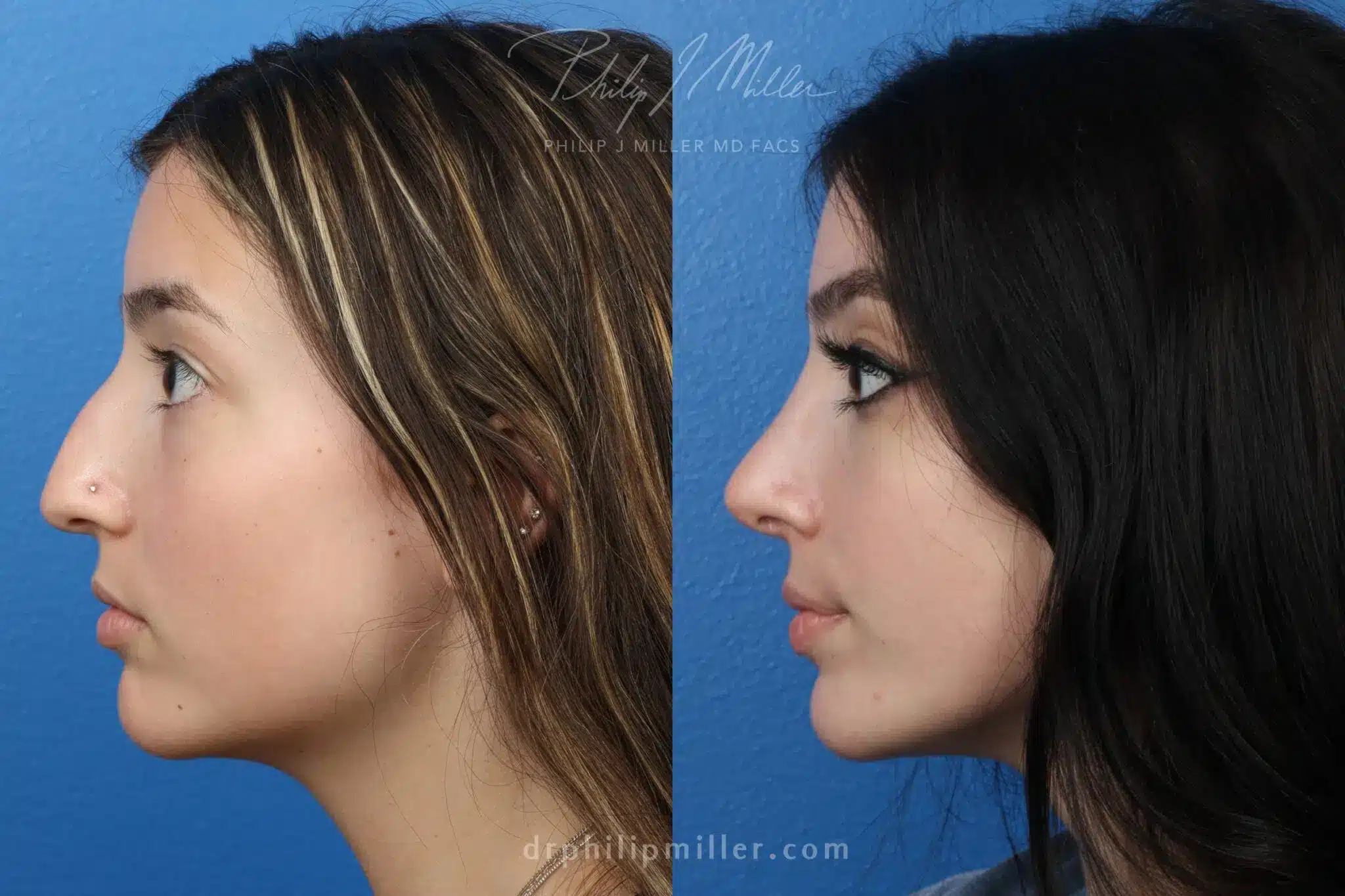 rhinoplasty recovery week by week