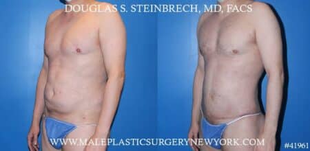 Torso Tuck with Body Banking to Pecs and Glutes by Dr. Steinbrech