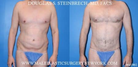 Torso Tuck with Body Banking to Pecs and Glutes by Dr. Steinbrech