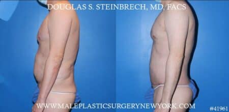 Torso Tuck with Body Banking to Pecs and Glutes by Dr. Steinbrech