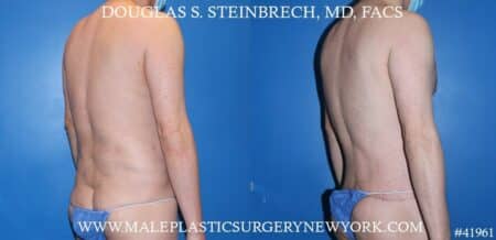 Torso Tuck with Body Banking to Pecs and Glutes by Dr. Steinbrech