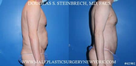 Torso Tuck with Body Banking to Pecs and Glutes by Dr. Steinbrech