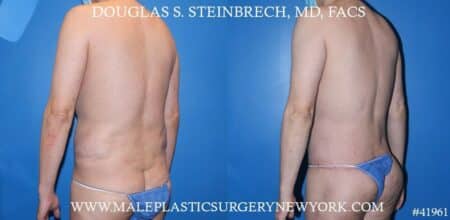 Torso Tuck with Body Banking to Pecs and Glutes by Dr. Steinbrech