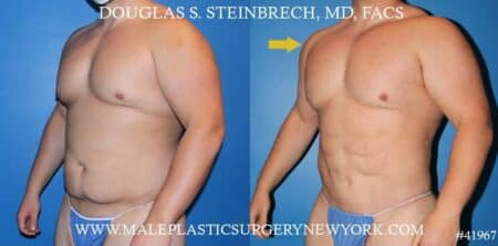 Torso tuck with body banking to augment the pecs and shoulders by Dr. Steinbrech