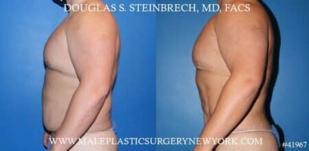 Torso tuck with body banking to augment the pecs and shoulders by Dr. Steinbrech