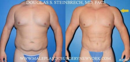 Torso tuck with body banking to augment the pecs and shoulders by Dr. Steinbrech