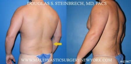 Torso tuck with body banking to augment the pecs and shoulders by Dr. Steinbrech