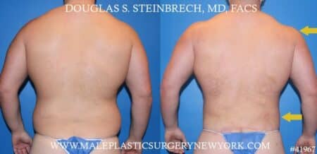 Torso tuck with body banking to augment the pecs and shoulders by Dr. Steinbrech