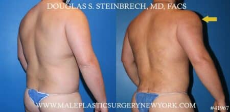 Torso tuck with body banking to augment the pecs and shoulders by Dr. Steinbrech