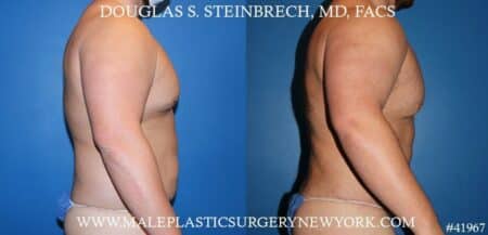 Torso tuck with body banking to augment the pecs and shoulders by Dr. Steinbrech