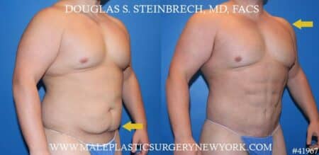 Torso tuck with body banking to augment the pecs and shoulders by Dr. Steinbrech