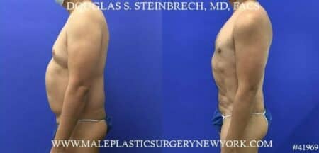 360 torso tuck with body banking to pecs, glutes, and shoulders by Dr. Steinbrech