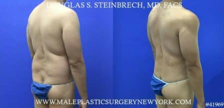 360 torso tuck with body banking to pecs, glutes, and shoulders by Dr. Steinbrech