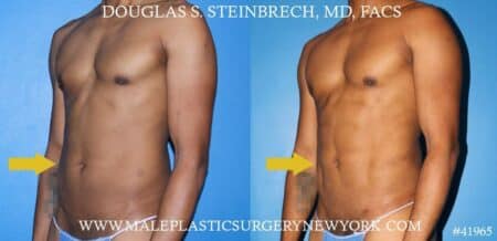 Liposuction to sculpt the torso of a male patient by Dr. Steinbrech