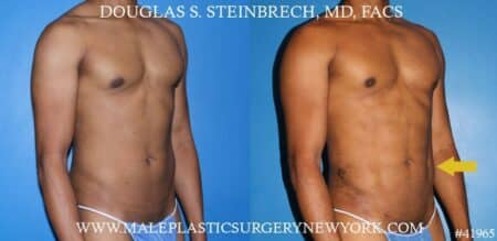 Liposuction to sculpt the torso of a male patient by Dr. Steinbrech