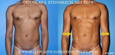 Liposuction to sculpt the torso of a male patient by Dr. Steinbrech