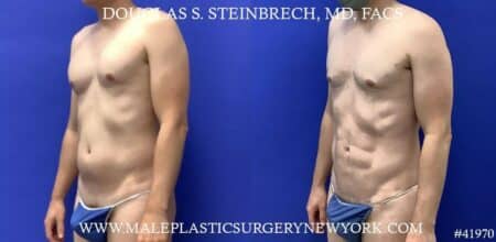 Liposuction with body banking to enhance the pecs by Dr. Steinbrech