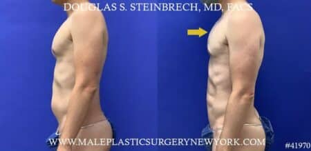 Liposuction with body banking to enhance the pecs by Dr. Steinbrech.