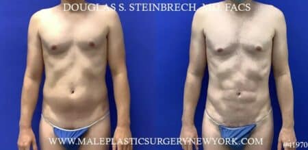 Liposuction with body banking to enhance the pecs by Dr. Steinbrech.